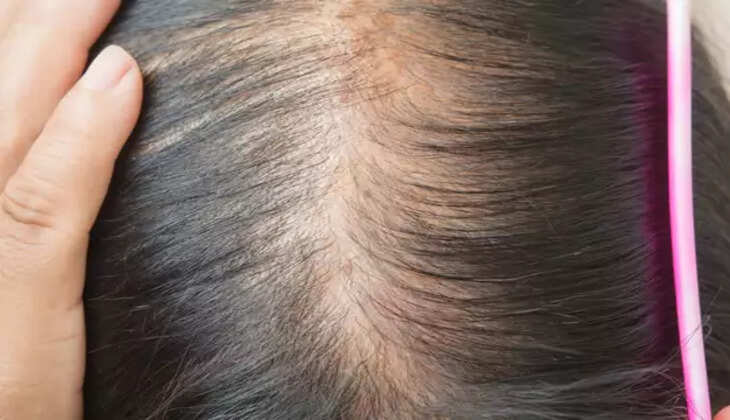Hair loss :आखिर क्यों कम उम्र में झड़ने लग जा रहे&nbsp;बाल, वजह जान दंग रह जाएंगे आप&nbsp;
