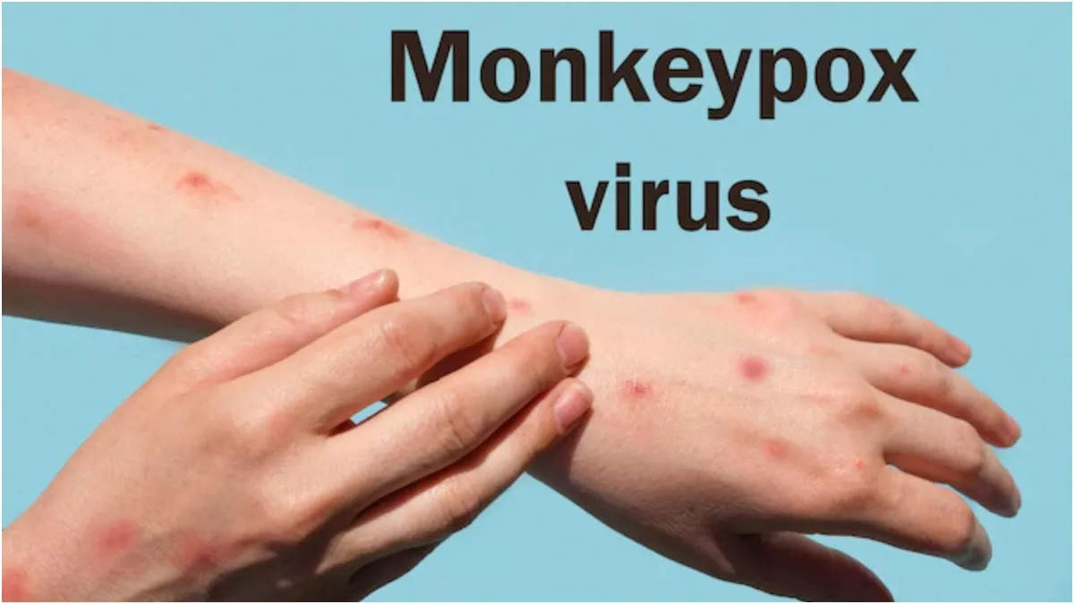 Monkeypox case in America: अमेरिका में मंकीपॉक्स से मौत का पहला मामला आया
