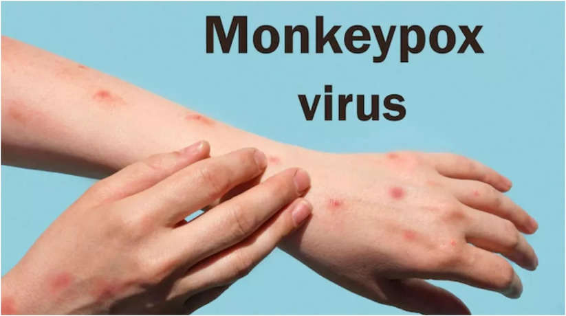 Monkeypox case in America: अमेरिका में मंकीपॉक्स से मौत का पहला मामला आया