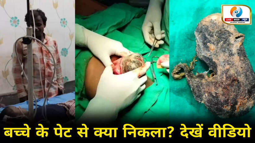 चन्दौली में बच्चे के पेट का ऑपरेशन, पेट अंदर ऐसी चीज देख डॉक्टर हो गए हैरान