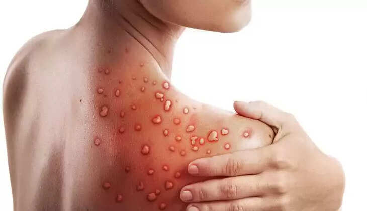 Monkeypox Alert: गाइडलाइन जारी, कॉन्टेक्ट ट्रेसिंग और 21 दिन का आइसोलेशन, यह रखें सावधानी
