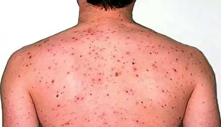 मंकीपॉक्स के मरीजों के&nbsp;लिए 10-10 बेड आरक्षित, एडवाइजरी जारी