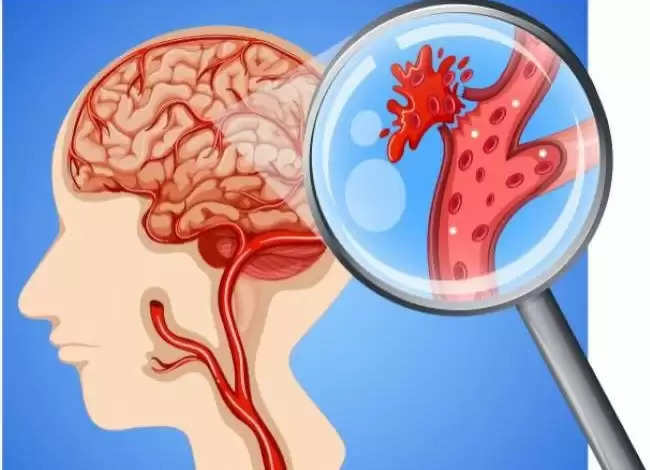 45% of Brain Hemorrhage Attacks Occur at Night: BHU के न्यूरोलॉजिस्ट बोले- रात में ब्लड प्रेशर बढ़ता है, नसों में जमा फैट मौत की वजह