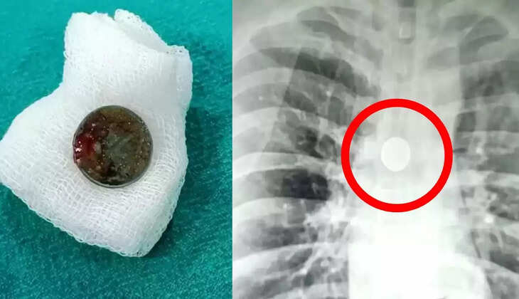 BHU के डॉक्टरों का कमाल! आठ साल से श्वास नली में अटकी चवन्नी को 20 मिनट में निकाला बाहर &nbsp; &nbsp; &nbsp; &nbsp; &nbsp; &nbsp; &nbsp; &nbsp;
