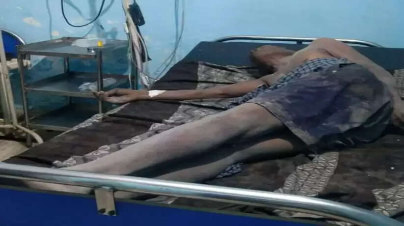 लटक रहे बिजली के तार के चपेट में आने से बूरी तरह झुलसा मजदूर