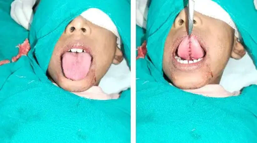 एलबीएस अस्पताल में हुआ चिपकी जीभ का सफल आपरेशन