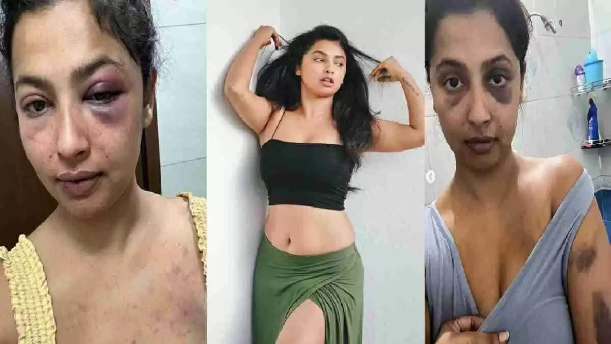 Ex boyfriend of famous actress brutally thrashed! This is how the face has become... expressed the pain by sharing the picture on social media!