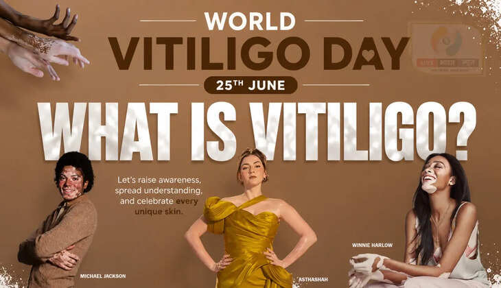 World Vitiligo Day :&nbsp;विटिलिगो सफेद दाग नहीं, त्वचा के रंग में बदलाव है! विटिलिगो को समझने और स्वीकारने की हैं जरूरत, जानें मिथक और सच्चाई